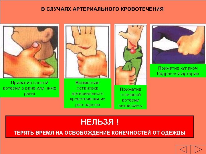 В СЛУЧАЯХ АРТЕРИАЛЬНОГО КРОВОТЕЧЕНИЯ Прижатие кулаком бедренной артерии Прижатие сонной артерии в ране или