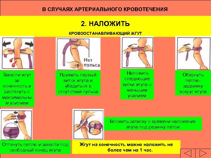 В СЛУЧАЯХ АРТЕРИАЛЬНОГО КРОВОТЕЧЕНИЯ 2. НАЛОЖИТЬ КРОВООСТАНАВЛИВАЮЩИЙ ЖГУТ Завести жгут за конечность и растянуть