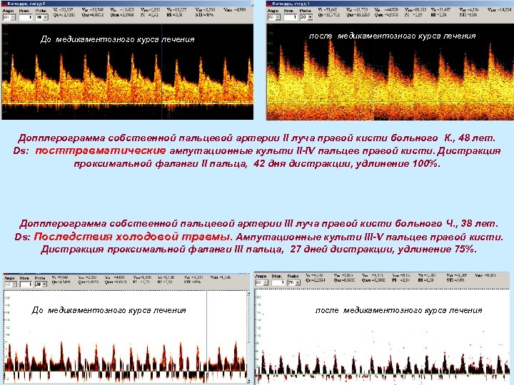 До медикаментозного курса лечения после медикаментозного курса лечения Допплерограмма собственной пальцевой артерии II луча