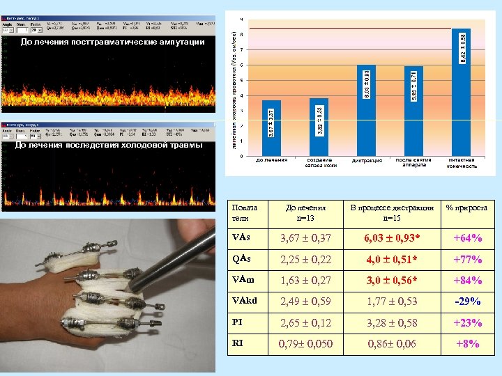 До лечения посттравматические ампутации До лечения последствия холодовой травмы Показа тели До лечения n=13