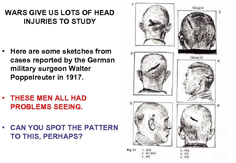 WARS GIVE US LOTS OF HEAD INJURIES TO STUDY • Here are some sketches