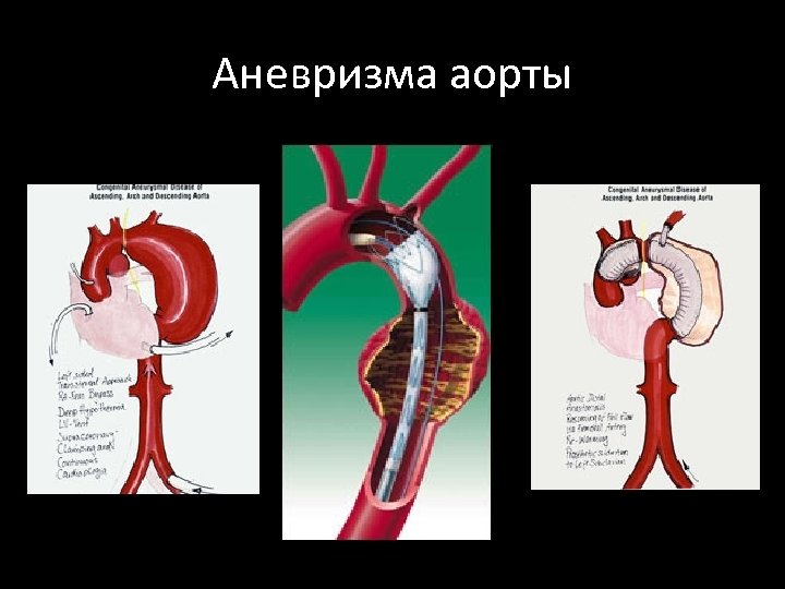 Аневризма аорты 