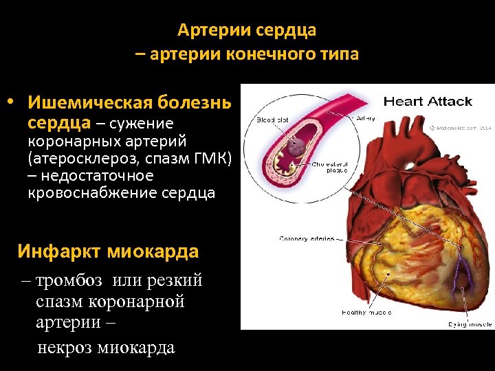Артерии сердца – артерии конечного типа • Ишемическая болезнь сердца – сужение коронарных артерий