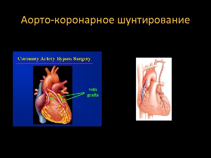 Аорто-коронарное шунтирование 