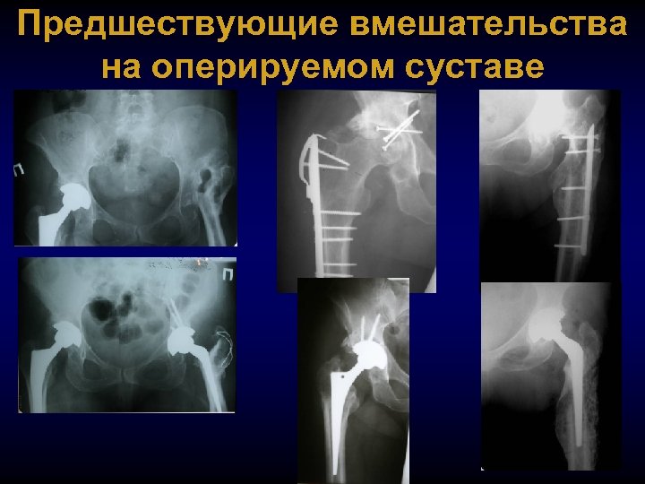 Предшествующие вмешательства на оперируемом суставе 