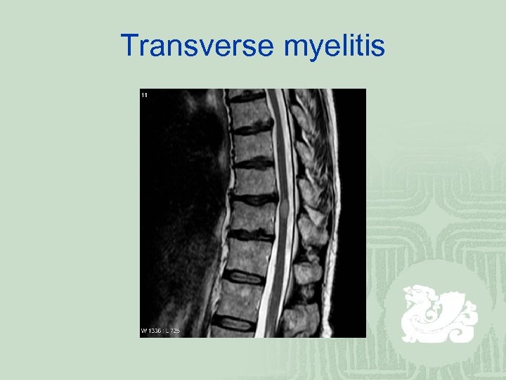 Transverse myelitis 