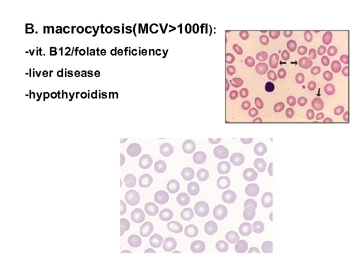B. macrocytosis(MCV>100 fl): -vit. B 12/folate deficiency -liver disease -hypothyroidism 