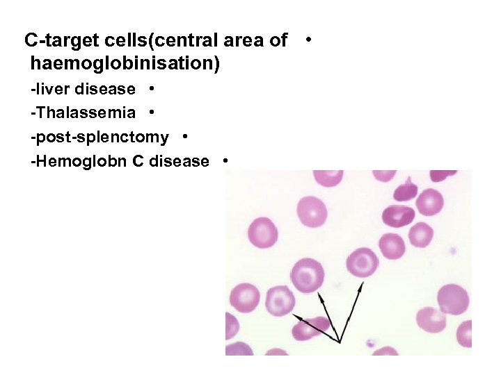 C-target cells(central area of • haemoglobinisation) -liver disease • -Thalassemia • -post-splenctomy • -Hemoglobn