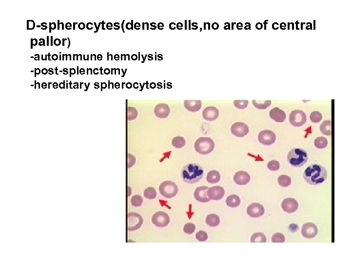 D-spherocytes(dense cells, no area of central pallor) -autoimmune hemolysis -post-splenctomy -hereditary spherocytosis 