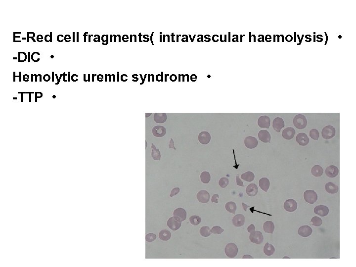 E-Red cell fragments( intravascular haemolysis) • -DIC • Hemolytic uremic syndrome • -TTP •