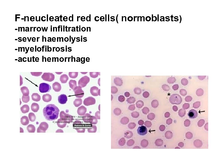 F-neucleated red cells( normoblasts) -marrow infiltration -sever haemolysis -myelofibrosis -acute hemorrhage 
