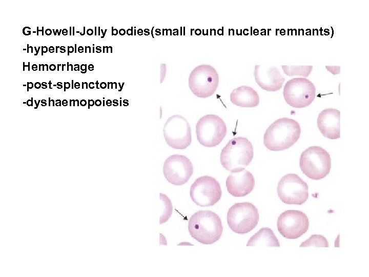 G-Howell-Jolly bodies(small round nuclear remnants) -hypersplenism Hemorrhage -post-splenctomy -dyshaemopoiesis 