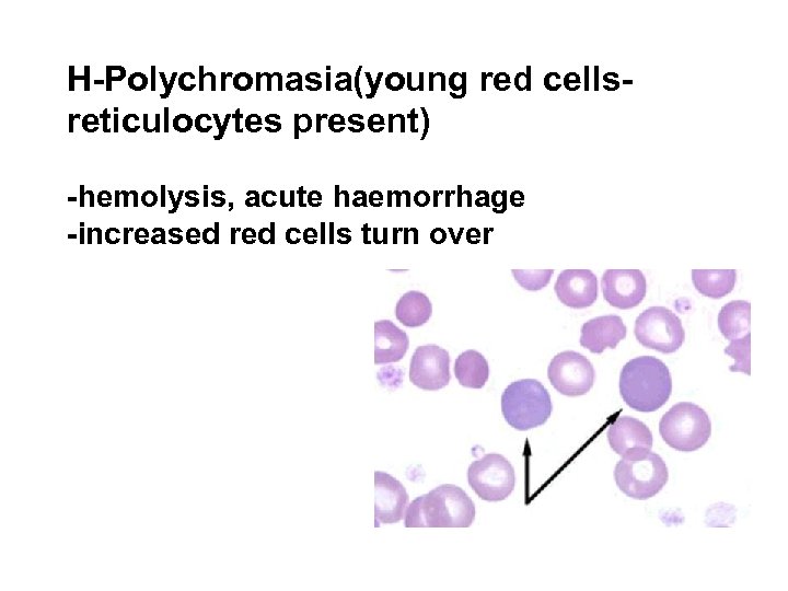 H-Polychromasia(young red cellsreticulocytes present) -hemolysis, acute haemorrhage -increased red cells turn over 