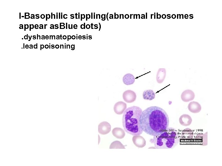 I-Basophilic stippling(abnormal ribosomes appear as. Blue dots). dyshaematopoiesis. lead poisoning 