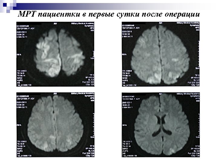 МРТ пациентки в первые сутки после операции 