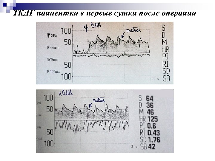 ТКДГ пациентки в первые сутки после операции 