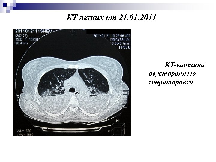 КТ легких от 21. 01. 2011 КТ-картина двустороннего гидроторакса 
