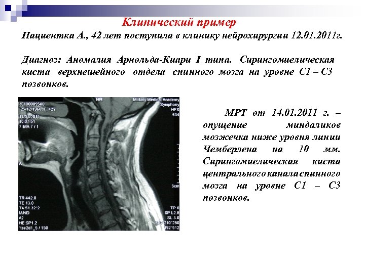 Клинический пример Пациентка А. , 42 лет поступила в клинику нейрохирургии 12. 01. 2011