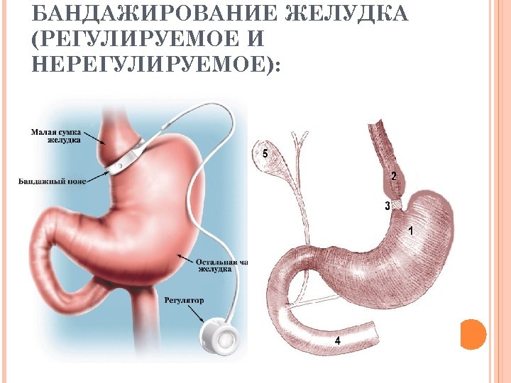 Желудок отзывы. Бандажирование желудка операция. Регулируемое бандажирование желудка. Лапароскопическое бандажирование желудка. Регулируемое кольцо желудка.