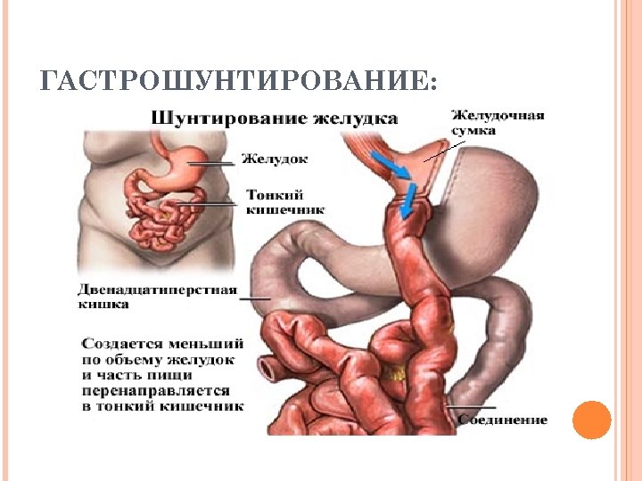 ГАСТРОШУНТИРОВАНИЕ: 