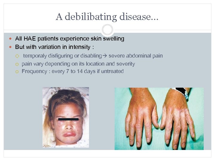 A debilibating disease… All HAE patients experience skin swelling But with variation in intensity