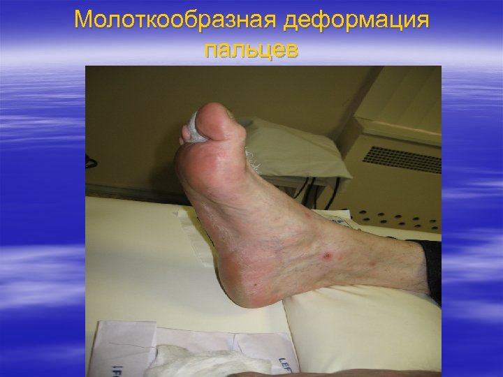 Молоткообразная деформация пальцев 