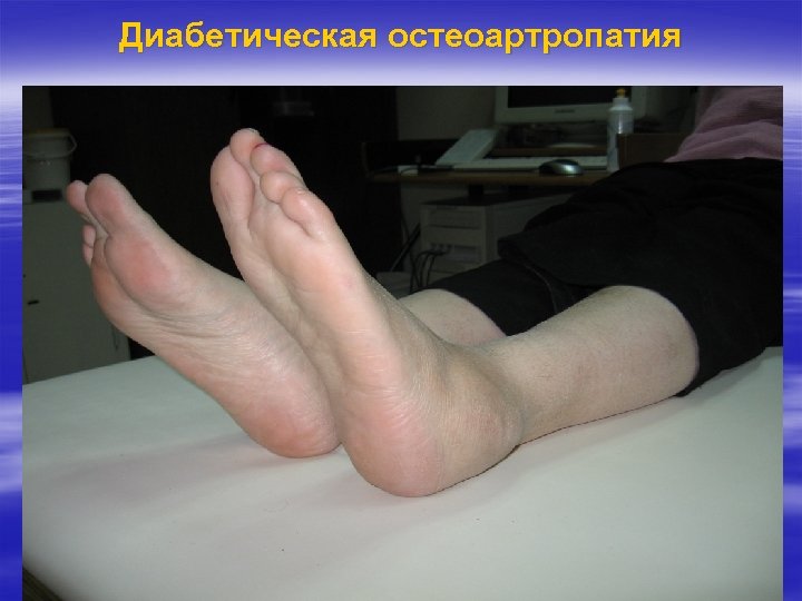 Диабетическая остеоартропатия 