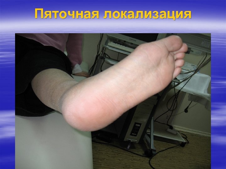 Пяточная локализация 