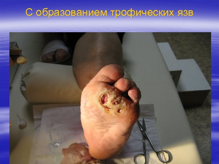 С образованием трофических язв 