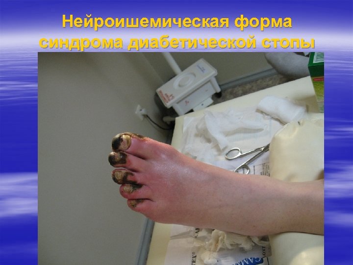 Нейроишемическая форма синдрома диабетической стопы 