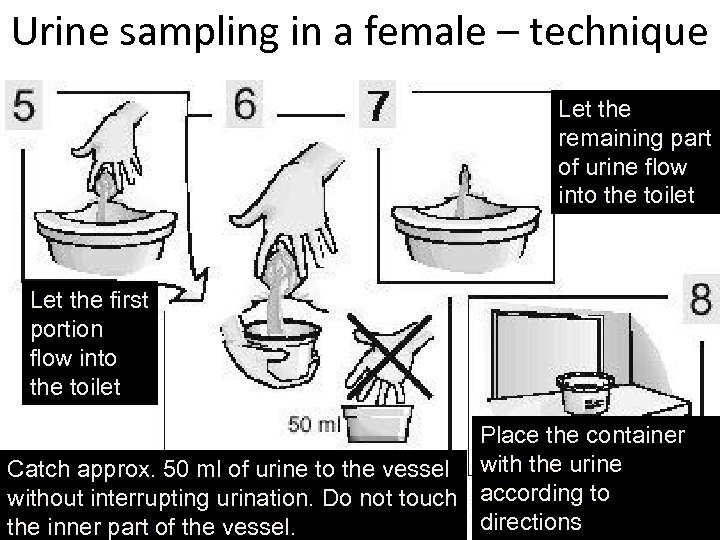 Urine sampling in a female – technique Let the remaining part of urine flow