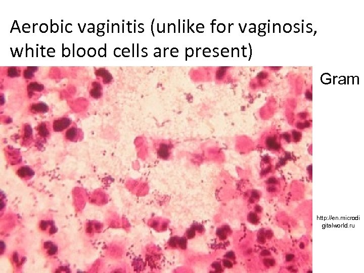 Aerobic vaginitis (unlike for vaginosis, white blood cells are present) Gram http: //en. microdi