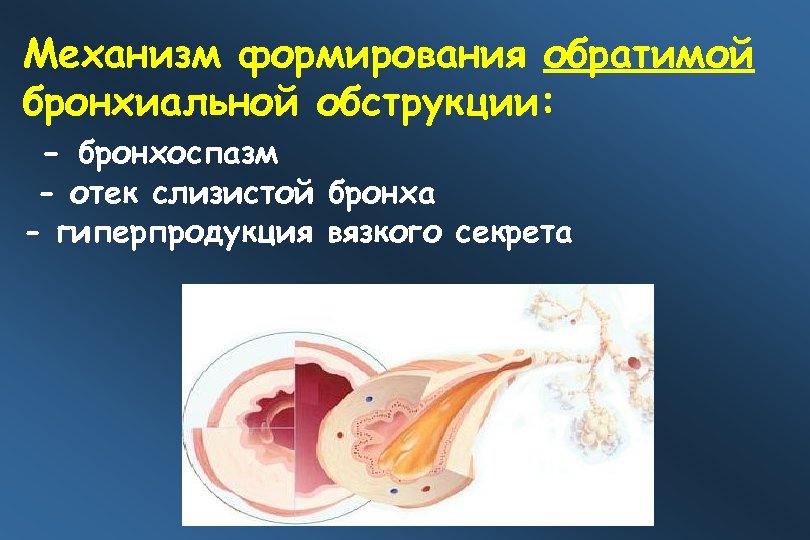 Механизм формирования обратимой бронхиальной обструкции: - бронхоспазм - отек слизистой бронха - гиперпродукция вязкого