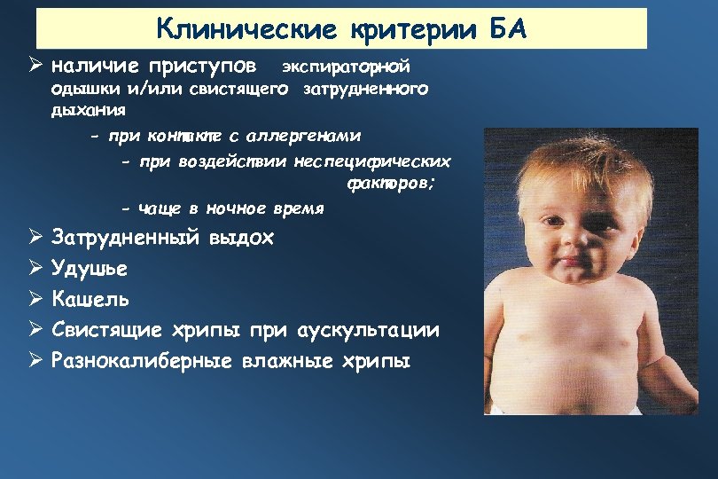 Клинические критерии БА наличие приступов экспираторной одышки и/или свистящего затрудненного дыхания - при контакте