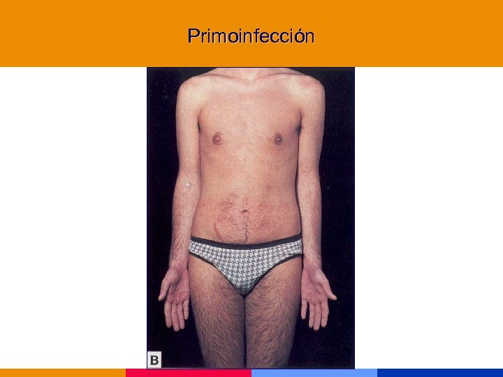 Primoinfección 