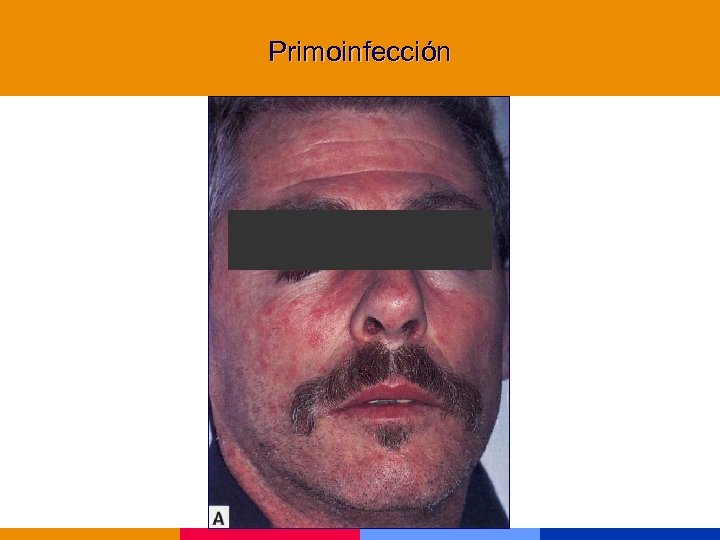 Primoinfección 