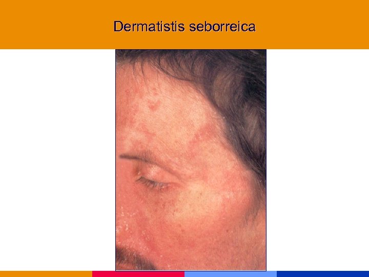Dermatistis seborreica 