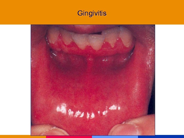 Gingivitis 
