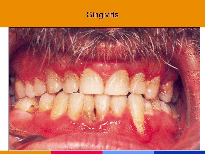 Gingivitis 