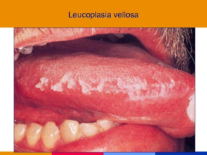 Leucoplasia vellosa 