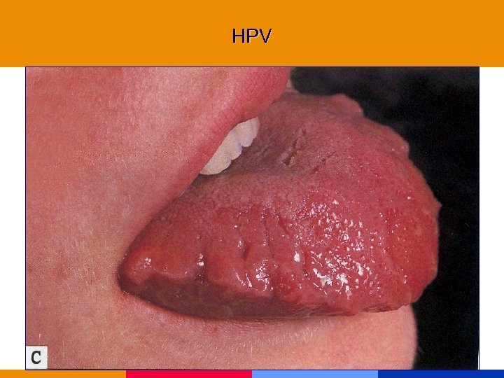 HPV 