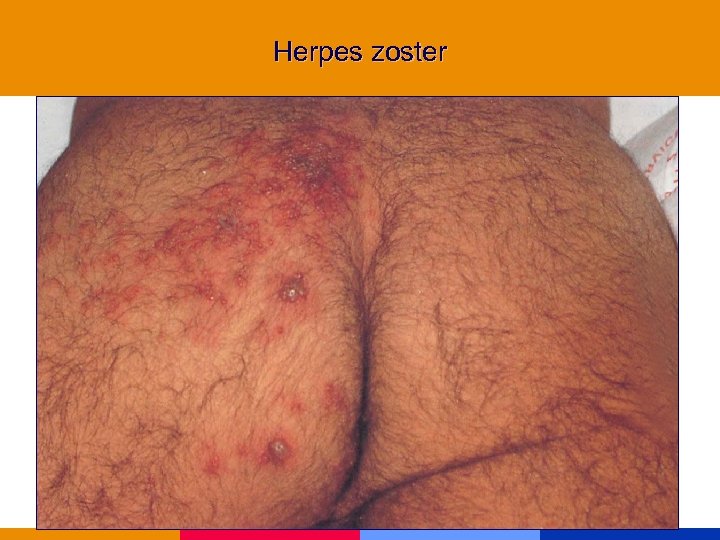 Herpes zoster 
