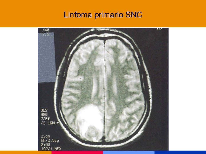 Linfoma primario SNC 