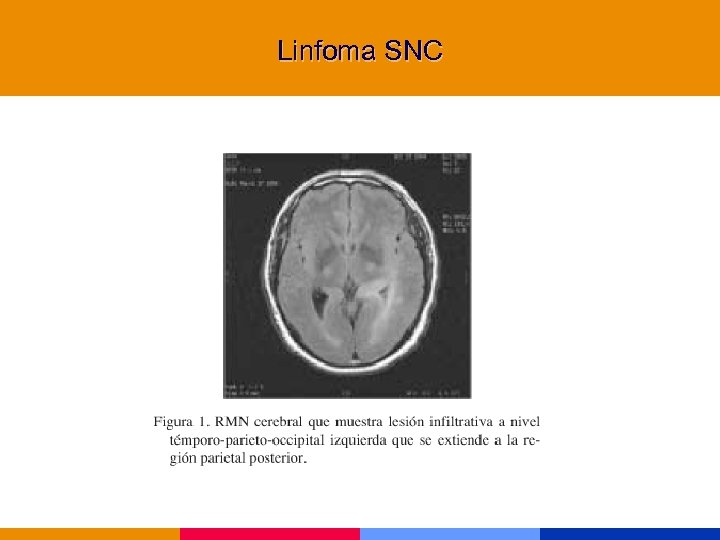 Linfoma SNC 