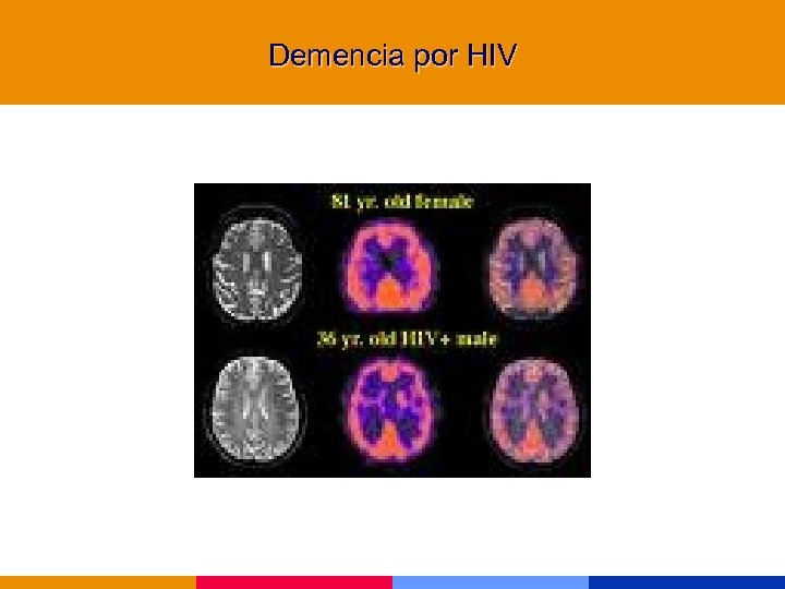 Demencia por HIV 