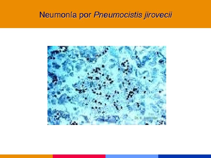 Neumonía por Pneumocistis jirovecii 