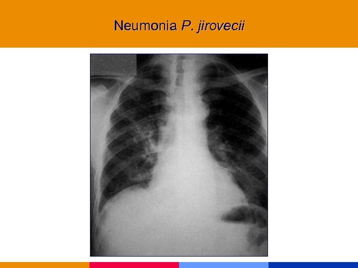 Neumonia P. jirovecii 