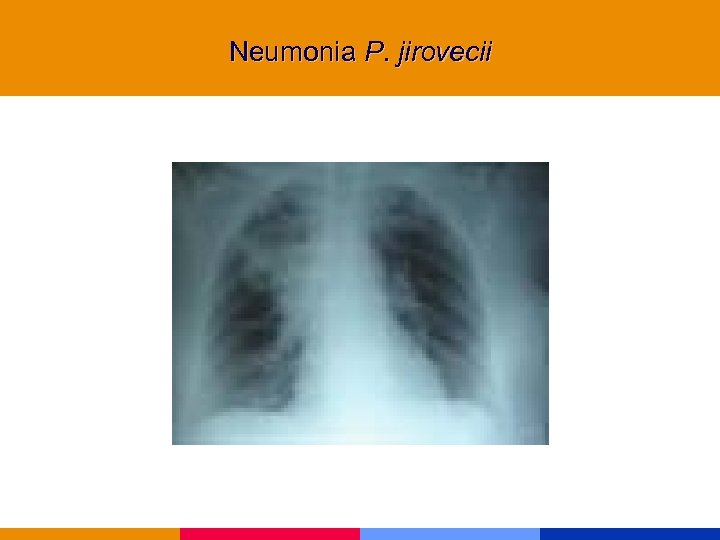 Neumonia P. jirovecii 