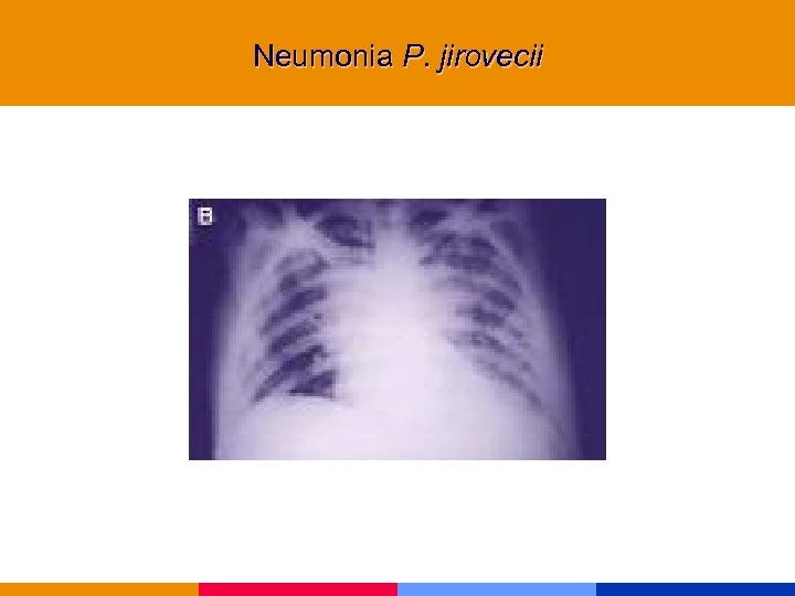 Neumonia P. jirovecii 