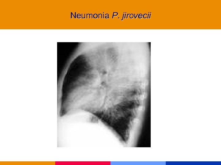 Neumonia P. jirovecii 